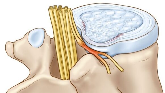 Protrusions of the intervertebral disc, which occur in thoracic osteochondrosis, compress the nerve endings
