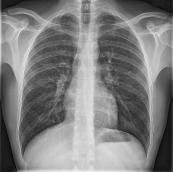 The diagnosis of osteochondrosis of the thoracic spine is made using X-rays