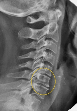 Osteochondrosis of the cervical spine on an X rays