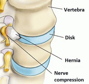 Osteochondrosis of the cervix region