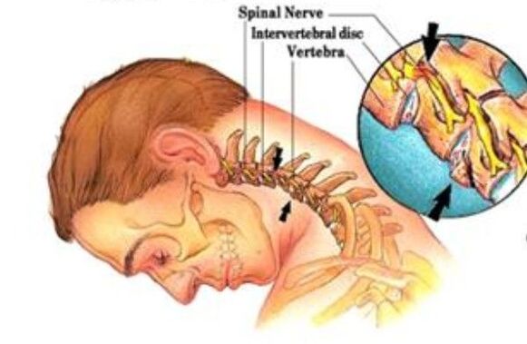 cervical osteochondrosis