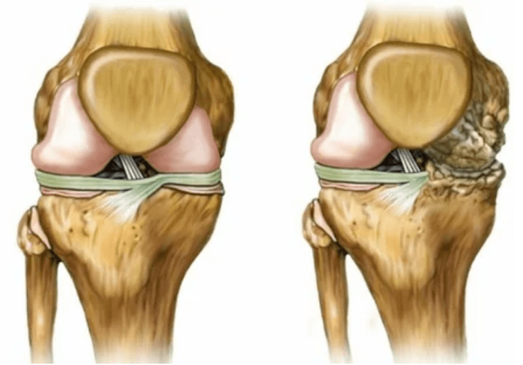 Arthrosis stadiums
