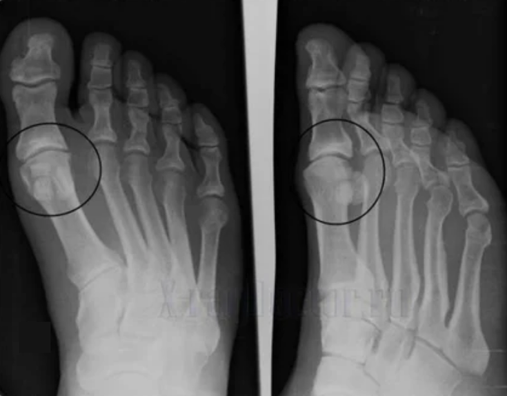 Diagnosis of osteoarthritis