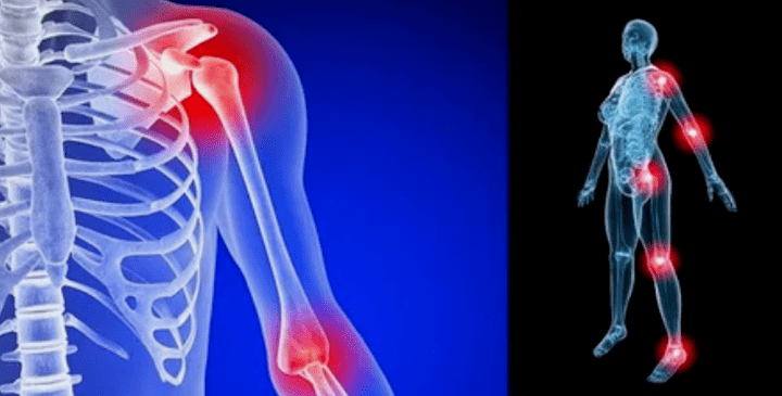 Limitation of limbs for arthrosis