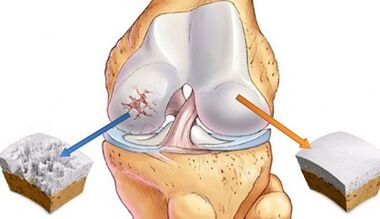 Causes of osteoarthritis of the joints