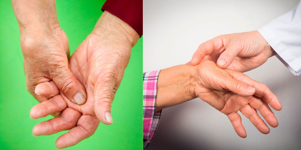 Swelling and aching pain are the first signs of hand osteoarthritis