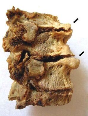 Vertebral segment affected by osteochondrosis