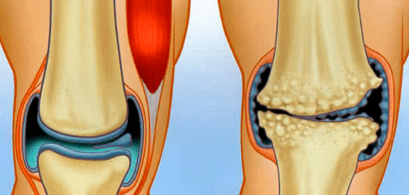 Normal joint and osteoarthritis